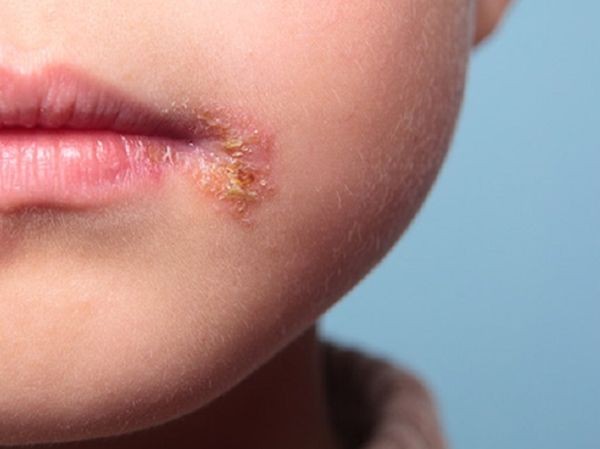 Кошмар в Сливен 11 годишно момиченце е диагностицирано със сифилис
